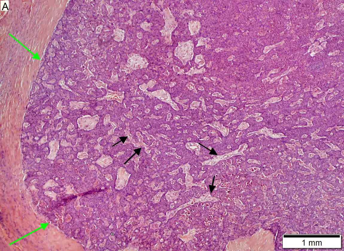 Low grade pancreatic neuroendocrine tumor