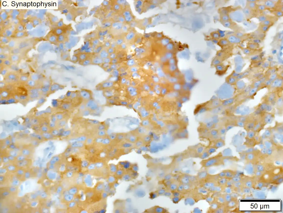 Low grade pancreatic neuroendocrine tumor