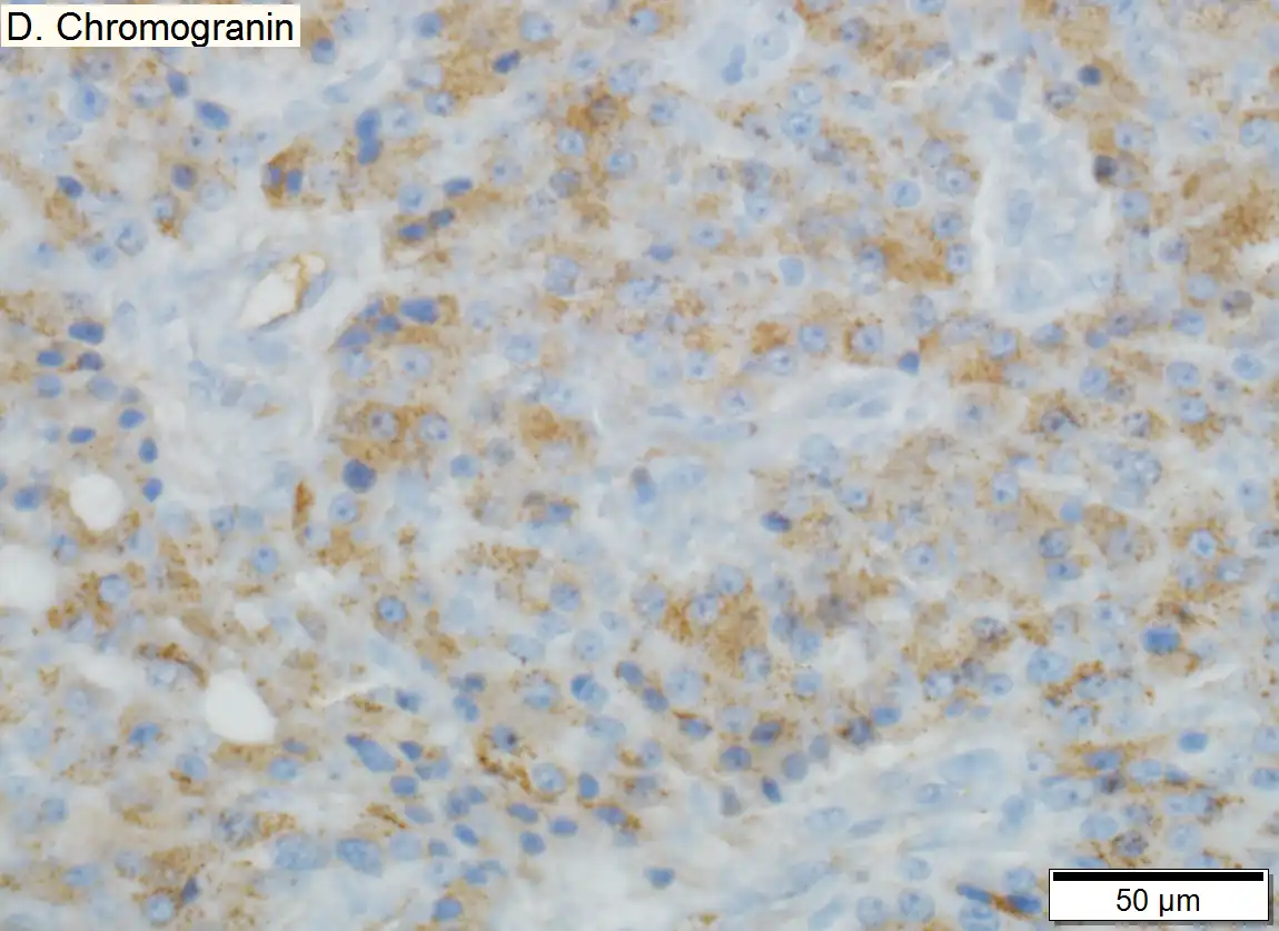 Low grade pancreatic neuroendocrine tumor