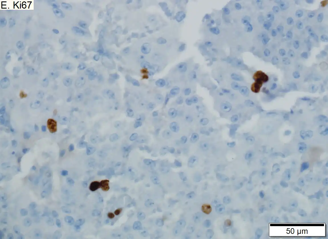 Low grade pancreatic neuroendocrine tumor